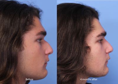 Functional Rhinoplasty before and after