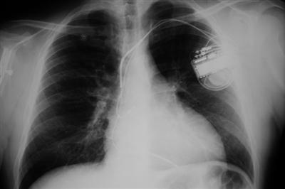 X-ray of a pacemaker in a chest
