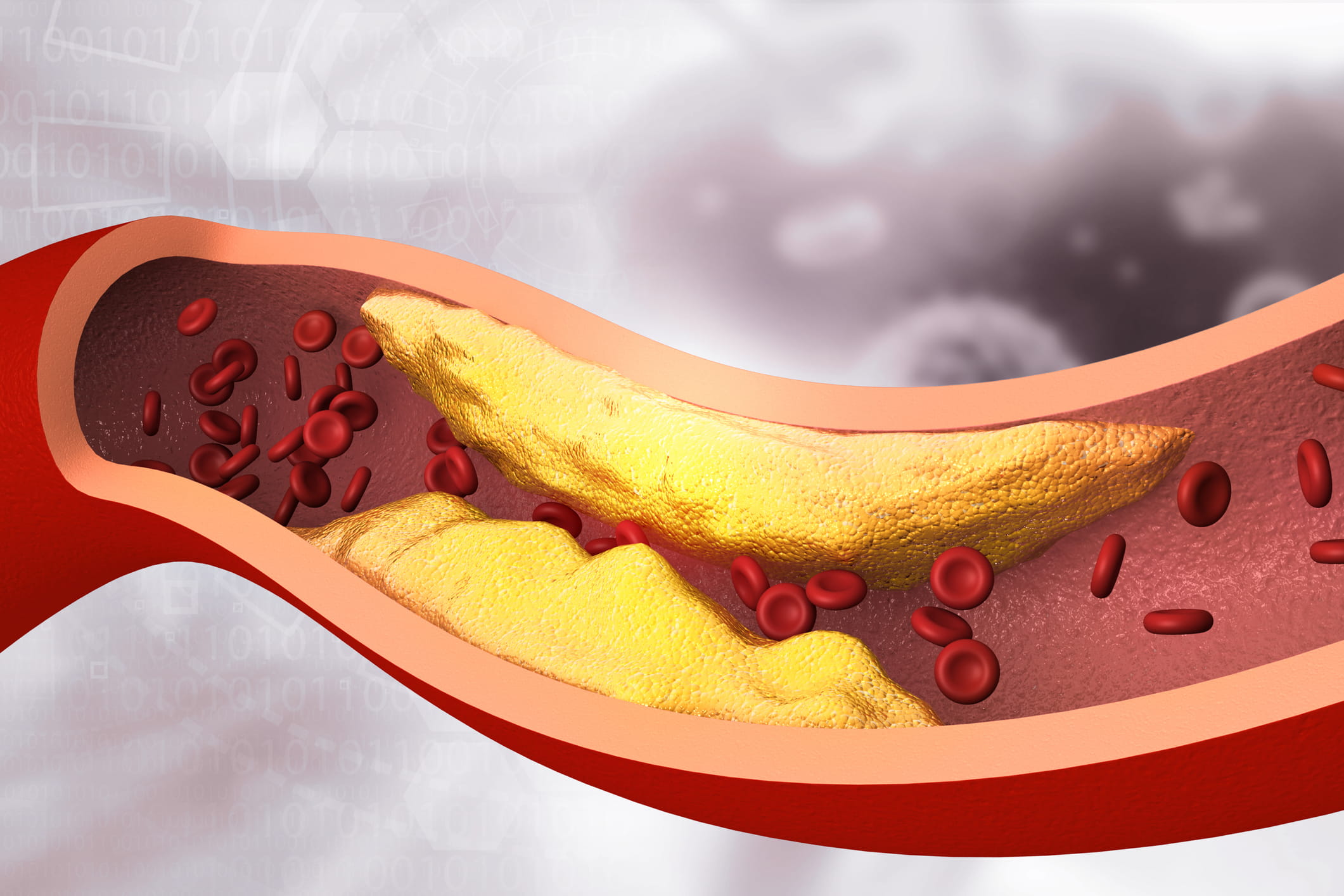 Clogged heart artery
