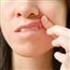 Canker sores