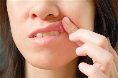 Blog – BOD-ities: Is there anything I can do about canker sores? | Main