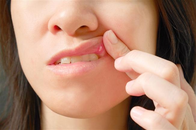 Canker sores Canker sores