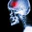 Stroke X-ray image