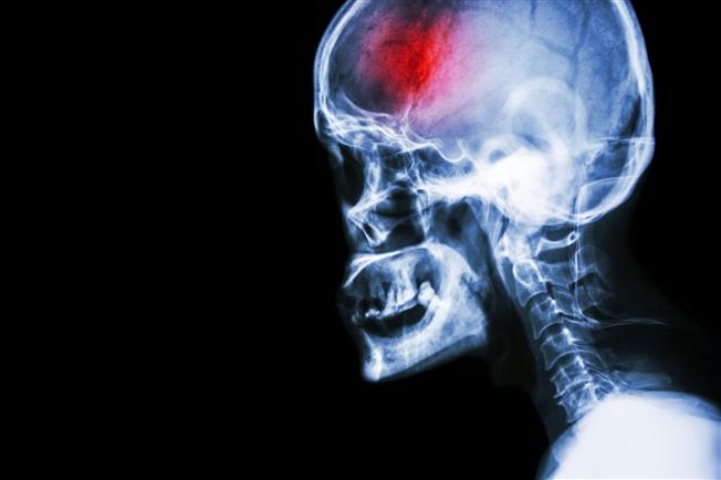 Stroke X-ray image Stroke X-ray image