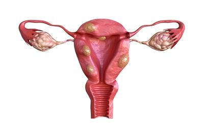 Uterine_fibroids