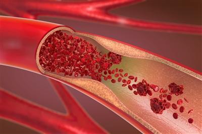 Constricted blood vessel