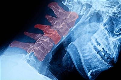 Xray film of neck bending Xray film of neck bending