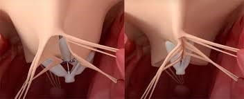 CLASP Tricuspid valve