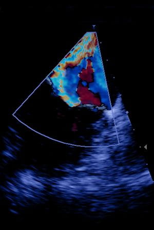 Screen of echocardiography (ultrasound) machine.