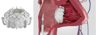 EVOKE Tricuspid valve