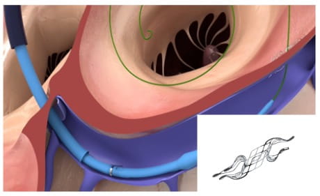 The APTURE shunt device on top of the ALT-FLOW II trial procedure