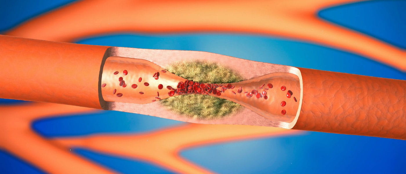 Illustration of an artery narrowed by atherosclerosis, showing yellow fatty plaque buildup along the inner wall that restricts blood flow.