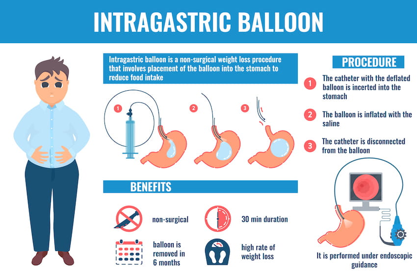 Intragastric Balloon Surgery Main Line Health