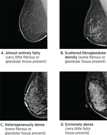 Breast Density Chart