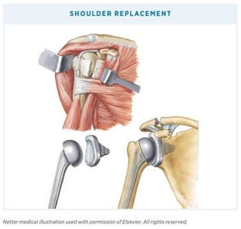 Shoulder Button Surgery Preparing for Shoulder Surgery | Your Guide to Shoulder Surgery | Main ...