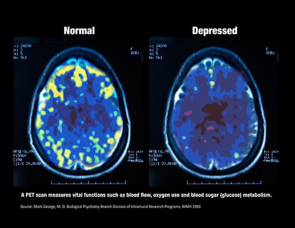 TMS brain scan