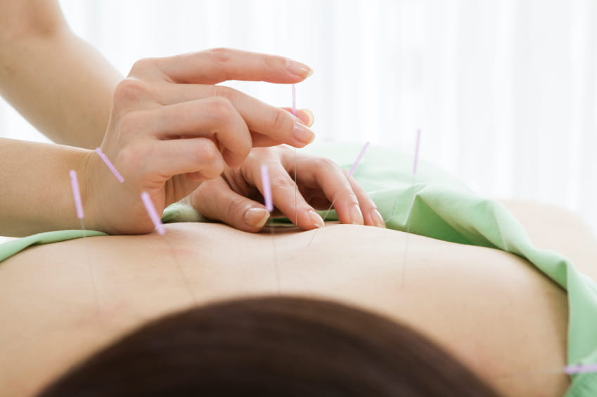 person getting acupuncture preformed on their back