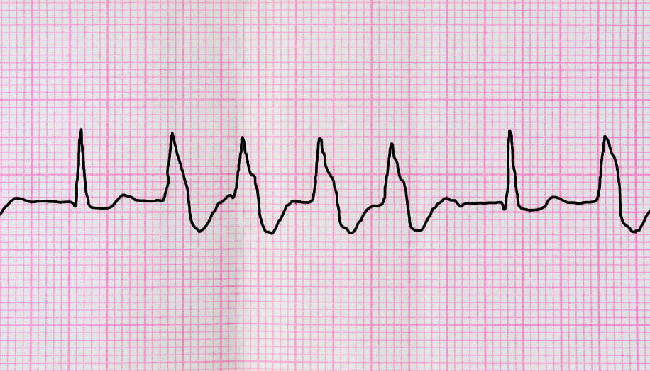 Should You Be Worried About Arrhythmia? Image 1 Tape ECG with group ventricular extrasystoles