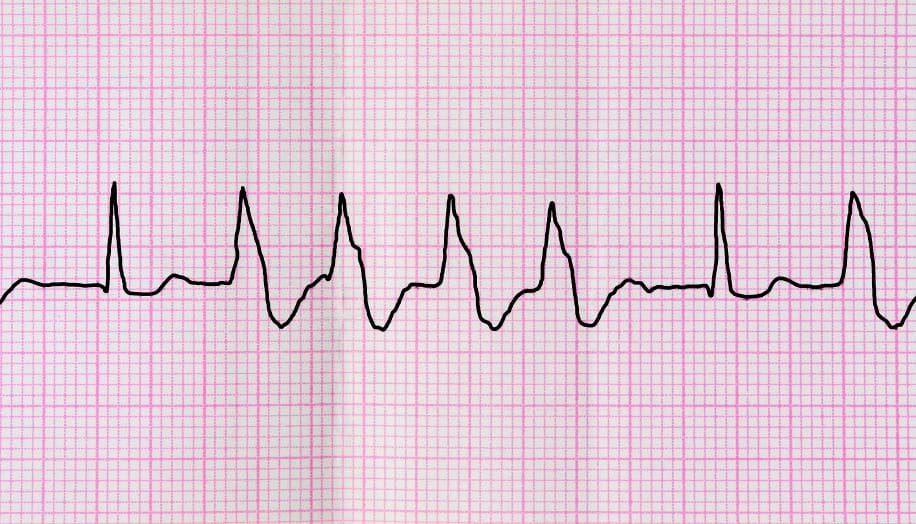 Tape ECG with group ventricular extrasystoles