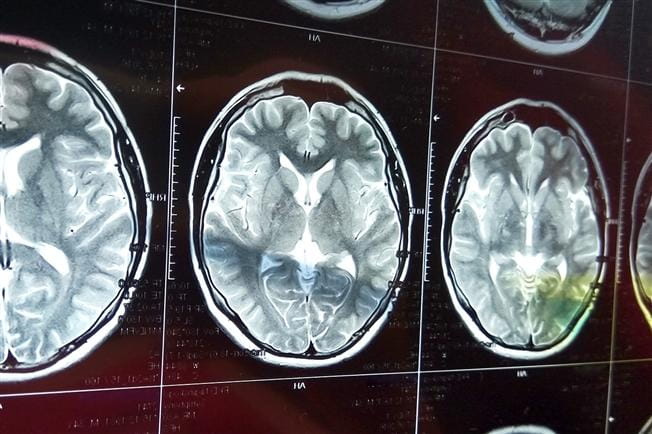Magnetic resonance scan of the brain with skull