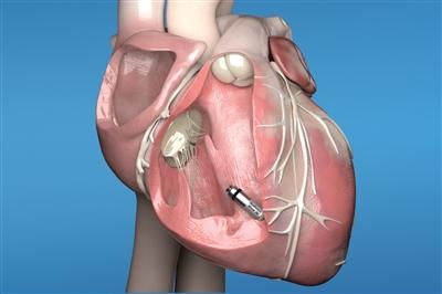 Illustration showing the Micra AV inside of a heart