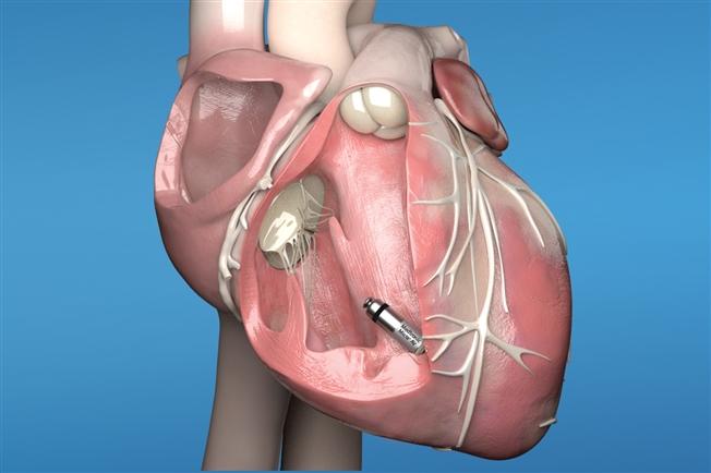 Illustration showing the Micra AV inside of a heart Illustration showing the Micra AV inside of a heart
