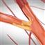 Carotid artery disease