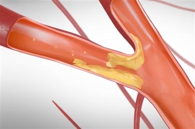 Carotid artery disease