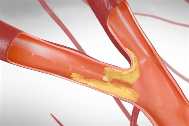 Carotid artery disease