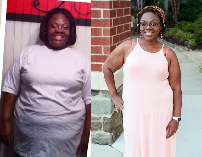 gastric bypass before and after black women