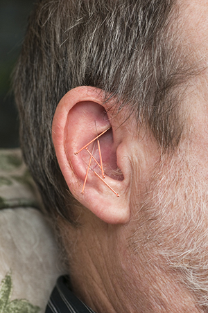 Close-up picture of acupuncture needs in an ear